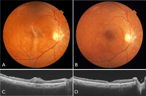 Fundus And Optical Coherence Tomography Oct Findings In The Right Eye