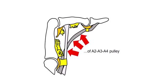 Technique Of A2 And A4 Flexor Tendon Pulley Reconstruction For Multiple