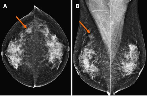 Breast Adenoid Cystic Carcinoma Arising In Microglandular Adenosis A