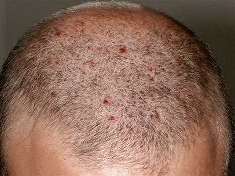 Sores And Scabs On Scalp Causes Treatment And Prevention Vlrengbr