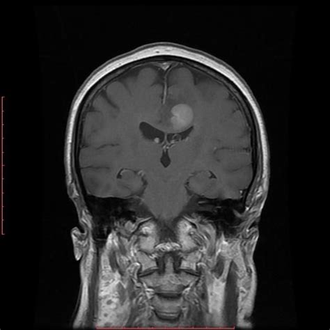 Primary Cns Lymphoma Of The Brain Radiology Case