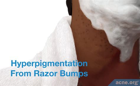 What Are Razor Bumps Acne Org