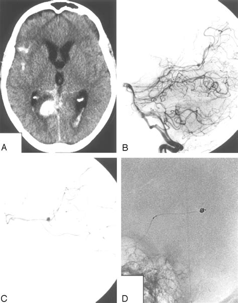 Endovascular Treatment Of Posterior Cerebral Artery Aneurysms
