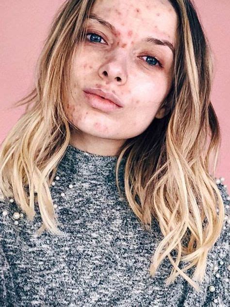 21 Best Free The Pimple Images In 2020 Acne Girl With Acne Skin