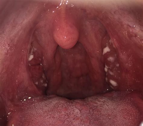 Are These Tonsil Stones Tonsilstones