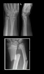 Fractura Marginal Del Extremo Distal Del Radio EcuRed