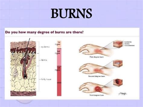Basic First Aid For Burns The O Guide