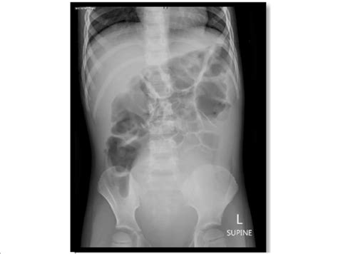 Abdominal Xray Showing Gas Distension Of The Transverse Colon