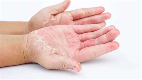 Trockene Haut Und Handekzeme Das Hilft Bei Neurodermitis Haut