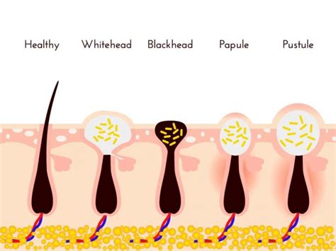 Whiteheads Causes Preventions And Treatments Home Remedies