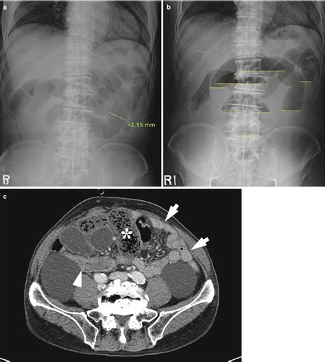 A large bowel (large intestine) obstruction is a blockage that keeps gas or stool from passing through what are the complications of large bowel obstruction? Small Bowel Obstruction | Radiology Key