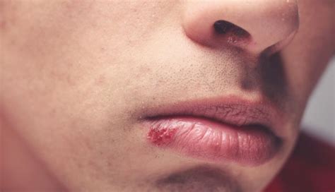 4 Natural Cold Sore Remedies That Really Work Top Health Issues