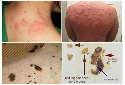 Old Bed Bug Bites On Black People Bed Decor