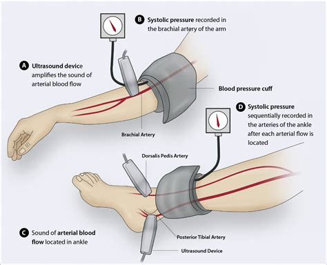 The Ankle Brachial Pressure Index Bpj 60 April 2014