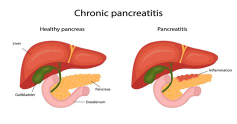 Signs Of An Inflamed Pancreas