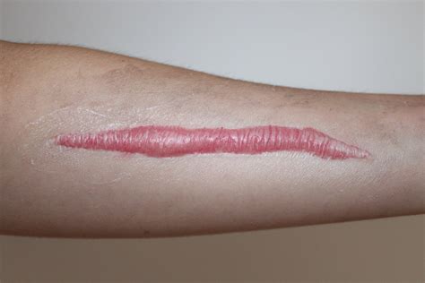 Hyper Realistic Thick Raised Keloid Scar Silicone Prosthetic Etsy