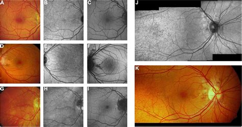 Near Infrared Reflectance Imaging And 488 Nm Fundus Autofluorescence