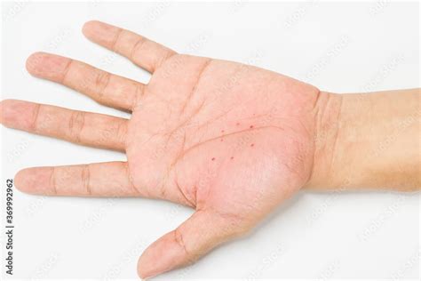 Atopic Dermatitis Ad On The Hand Also Known As Atopic Eczema Or
