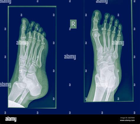 Una Radiografía Del Pie Que Muestra Una Fractura En La Falange Proximal