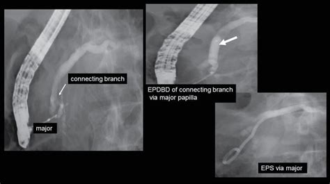 Usefulness And Safety Of Endoscopic Pancreatic Duct Balloon Dilation