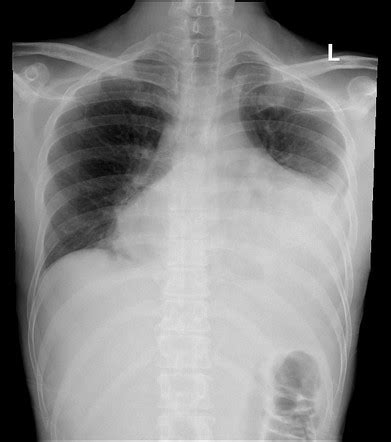 Tuberculous Pericardial Effusion Radiology Case Radiopaedia Org