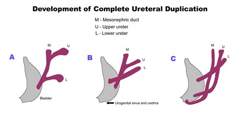 Line Diagram Shows Development Of Complete Ureteral Duplication