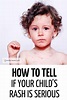 Spotty child? How to tell if your child's rash is serious. A great ...