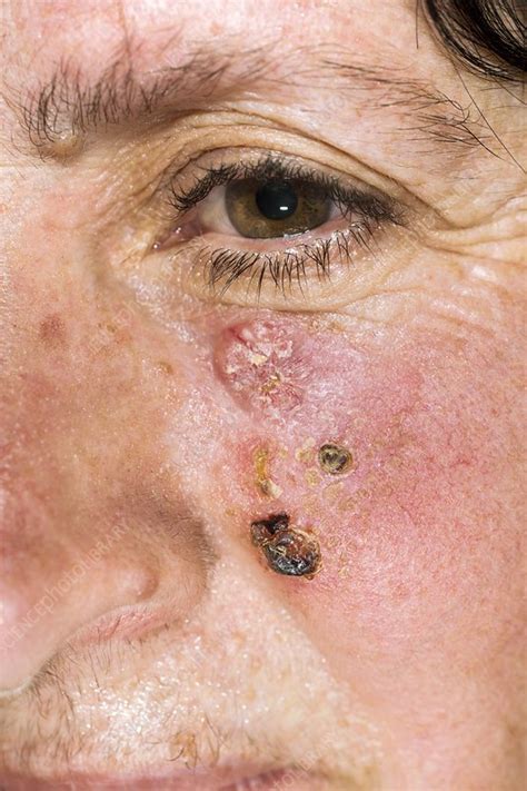 Basal Cell Skin Cancer On The Face Stock Image C Science My Xxx Hot Girl