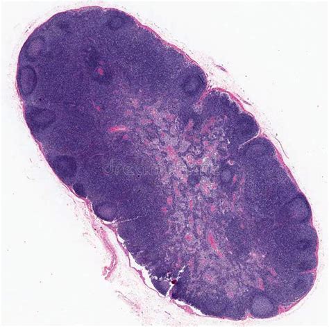 Lymph Node Stock Photo Image Of Infection Gland Lymphoma 18730720