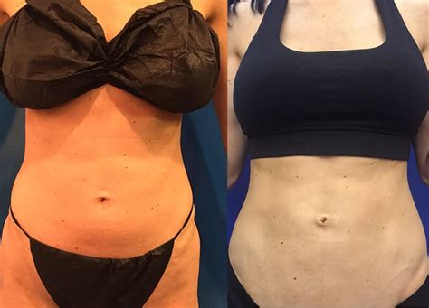 Abs Waist Liposuction Before After Neinstein Plastic Surgery