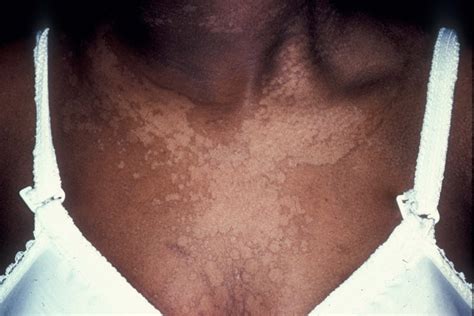 Tinea Versicolor Treatment Pictures Causes Symptoms Prevention Contagious Healthmd