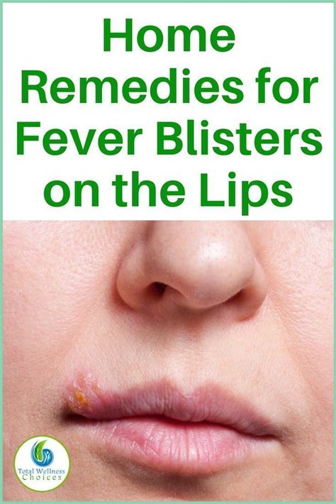 13 Natural Home Remedies For Fever Blisters On The Lips With Images