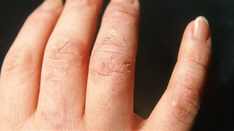 Mild Dyshidrotic Eczema Fingers