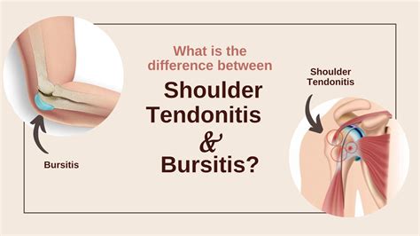 Difference Between Shoulder Tendonitis And Bursitis