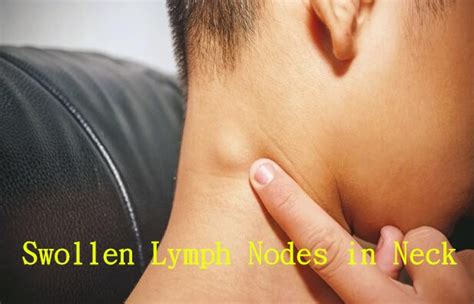 Top 17 Lymph Nodes Side Of Neck 2022