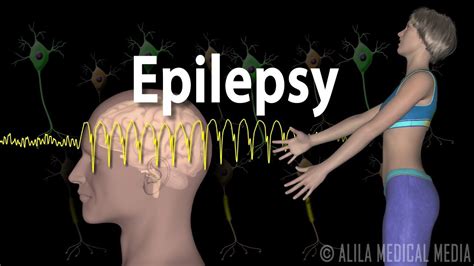 Epilepsy Animation Types Of Seizures Epilepsy Medical Videos