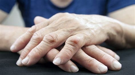 Artrite reumatoide o que é sintomas e tratamento