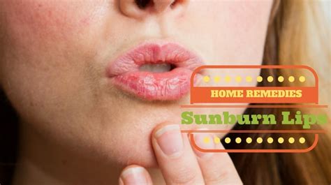 How To Heal Sunburned Lips Naturally