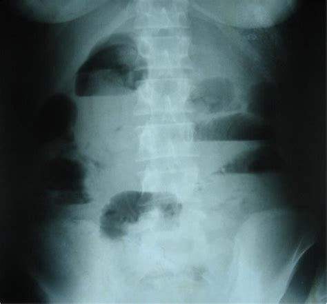 Upright Plain Abdominal X Ray Demonstrating A Small Bowel Obstruction