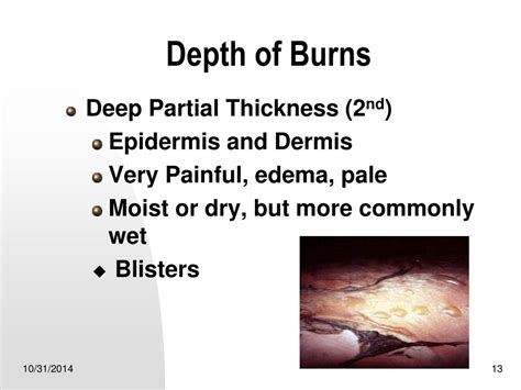 Ppt Burns Powerpoint Presentation Free Download Id6021518