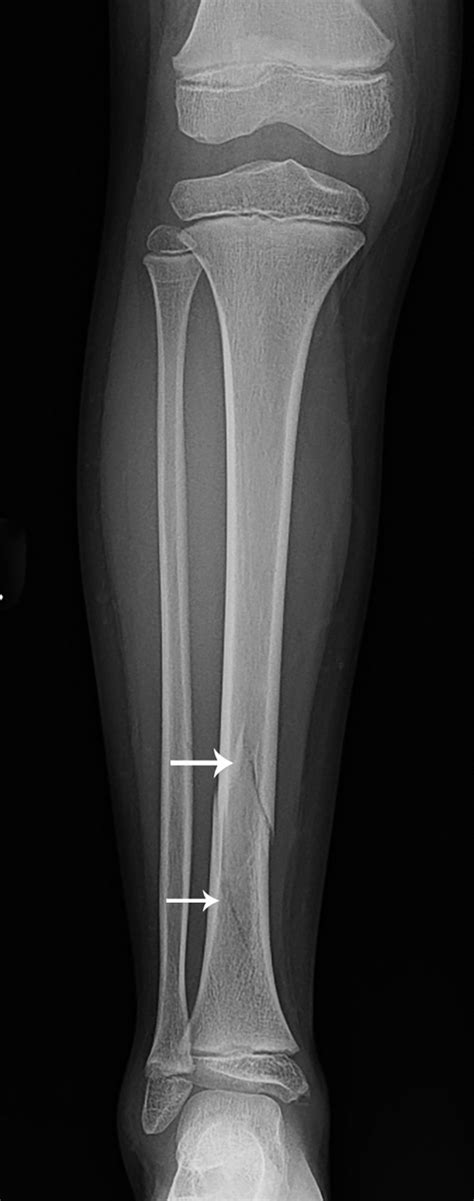 Tibia And Fibula Fractures Teachme Orthopedics