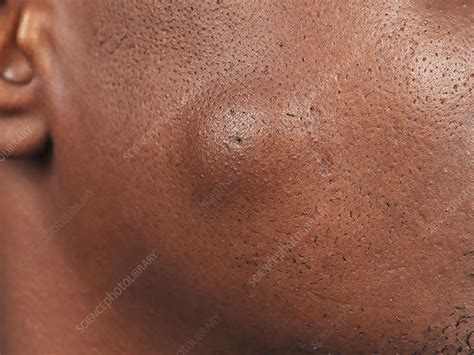 Sebaceous Cyst Stock Image C Science Photo Library