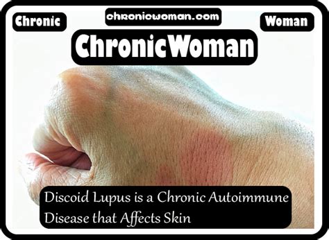 Discoid Lupus Is A Chronic Autoimmune Disease That Affects Skin Lupus
