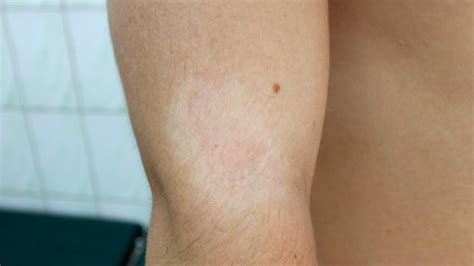 Pityriasis Alba Causes Symptoms And Treatments