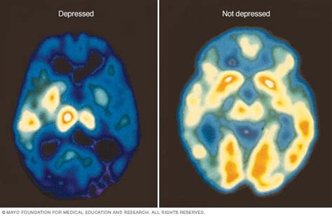 Depression Brain Scan Help Health
