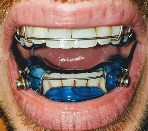 Pin von Mry Markay auf Braces and orthodontics Zähne Zahnspange