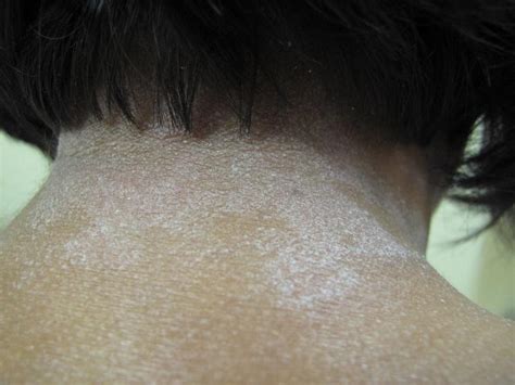 Eczema Of Neck On Black Skin With Lichenoid Patches Eczema In Skin Of