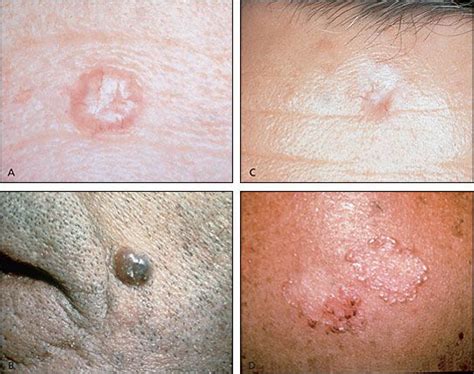 Common Types Of Basal Cell Carcinoma A Nodular B Pigmented C