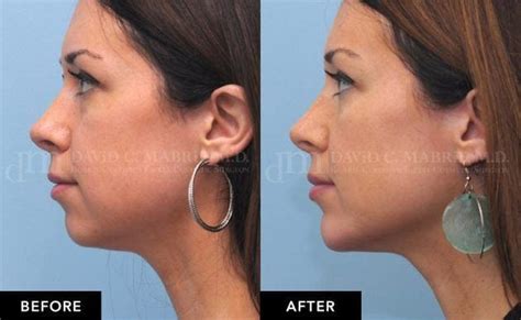 How Long Do Fillers Last The Definitive Guide In 2023 Facial Fillers