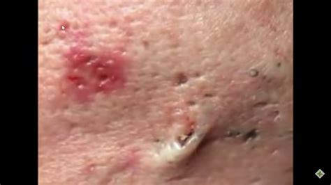 Large Blackheads Removal 003 Youtube